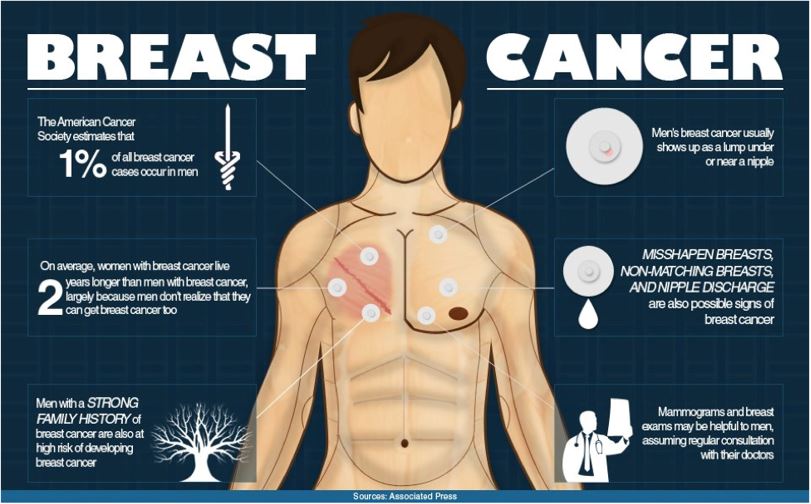 Male Breast Cancer